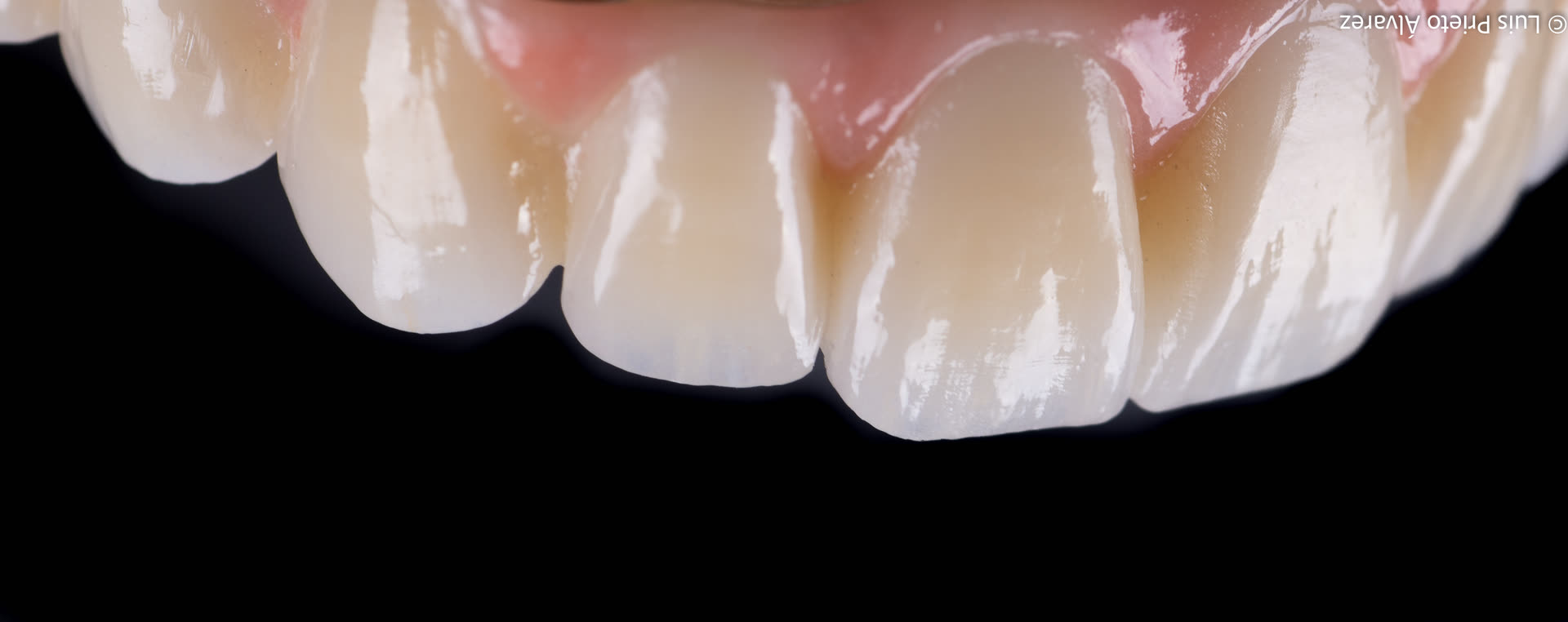 Estructura de prótesis sobre implantes diseñada con tecnología CAD-CAM en Innovadental
